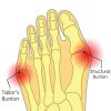 2pcs Soft Silicone Toe Hallux Valgus Separators (Suitable For Night And Home Use And Replace Them Regularly); Straighteners Bunion Relief Pads