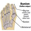 2pcs Soft Silicone Toe Hallux Valgus Separators (Suitable For Night And Home Use And Replace Them Regularly); Straighteners Bunion Relief Pads